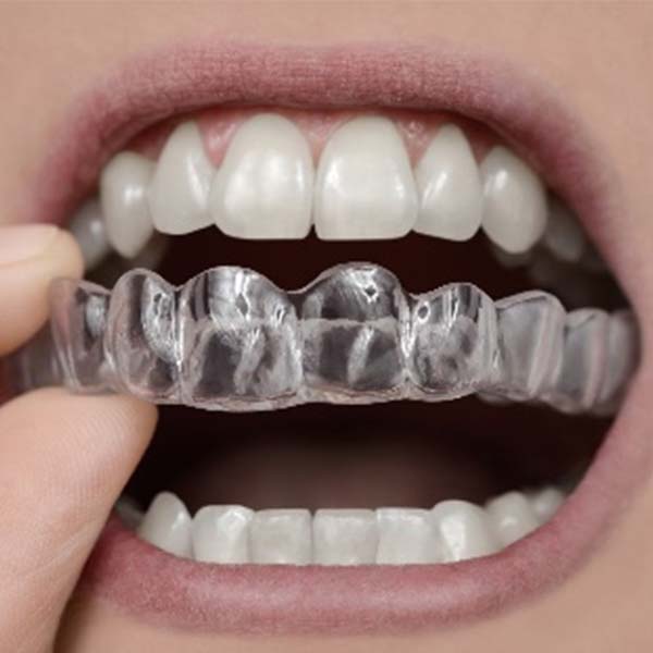 selfdentist-retainers