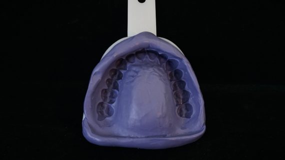 selfdentist after using trays selfdentist-after-using-trays